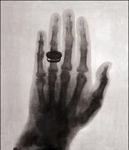 First Human X-Ray 1896